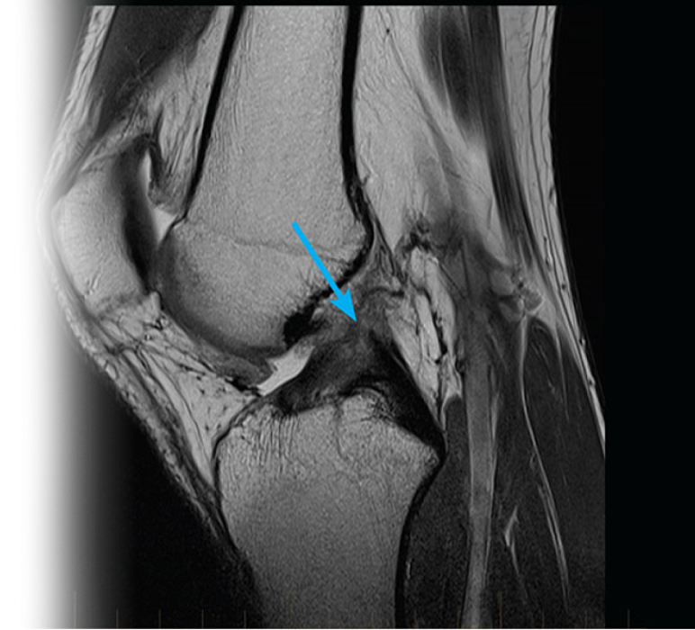 МРТ коленного сустава