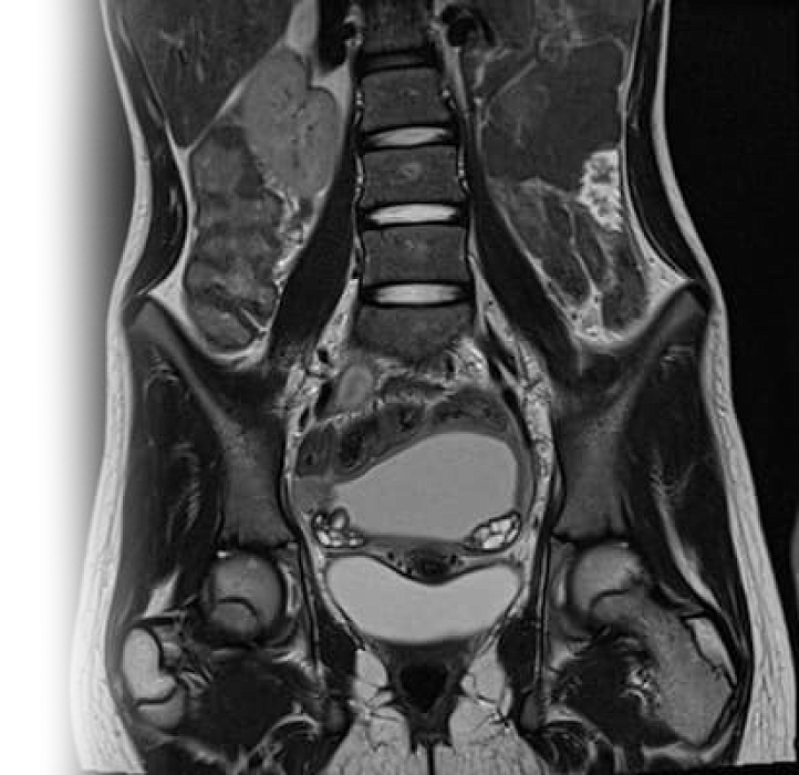МРТ костей таза