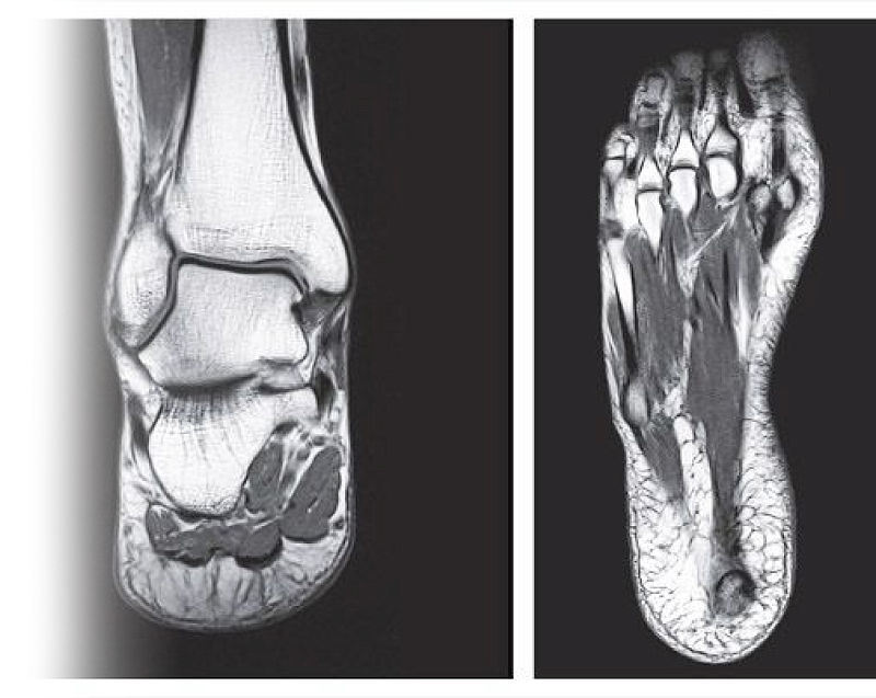 МРТ суставов стопы