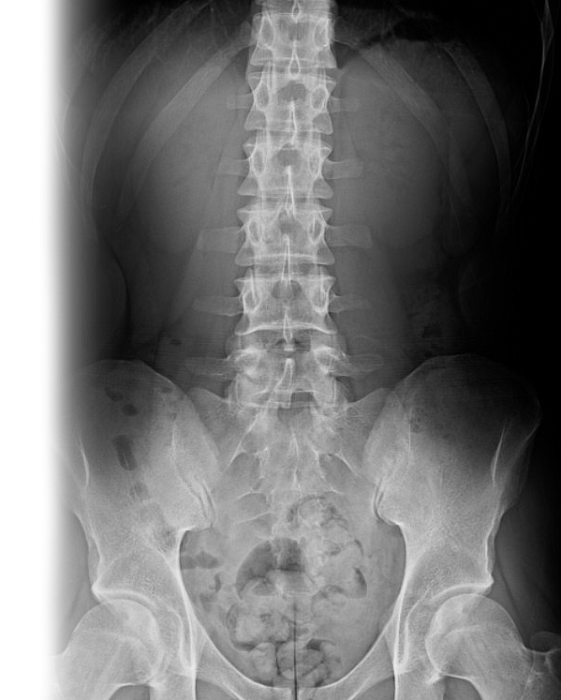 Рентгенография пояснично-крестцового отдела позвоночника