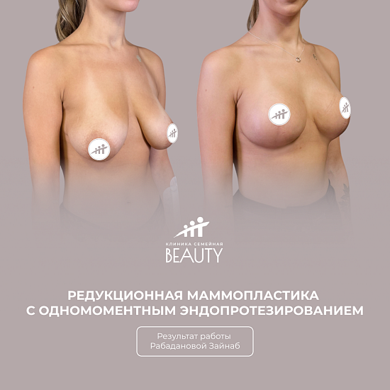 Примеры работ пластического хирурга Рабадановой З.М.