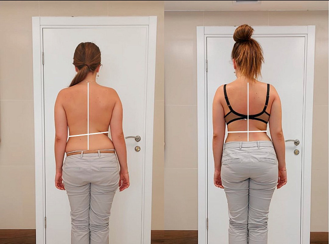 Берегите позвоночник смолоду