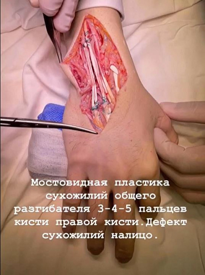 Перелом кисти хирурга