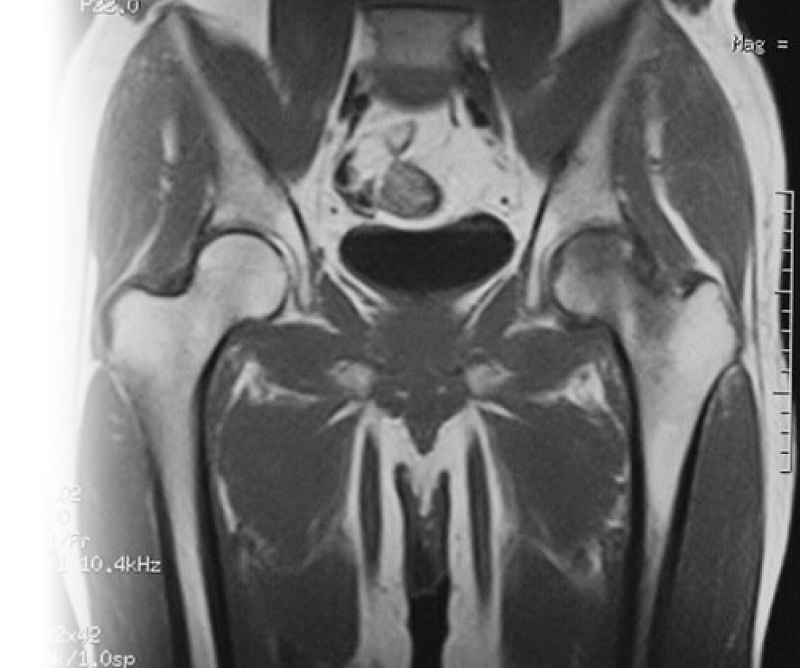 МРТ тазобедренных суставов