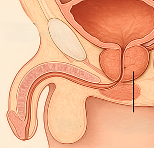 ТУР простаты