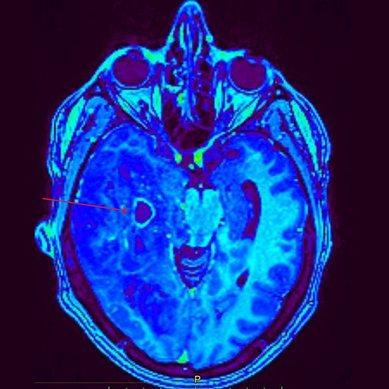Нарушение зрения на правый глаз и частая головная боль
