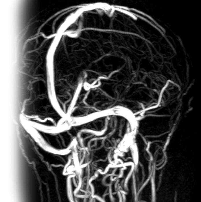 МР ангиография артерий и вен головного мозга