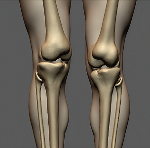 Артродез суставов