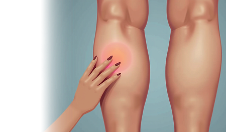 Перевязка перфорантных вен