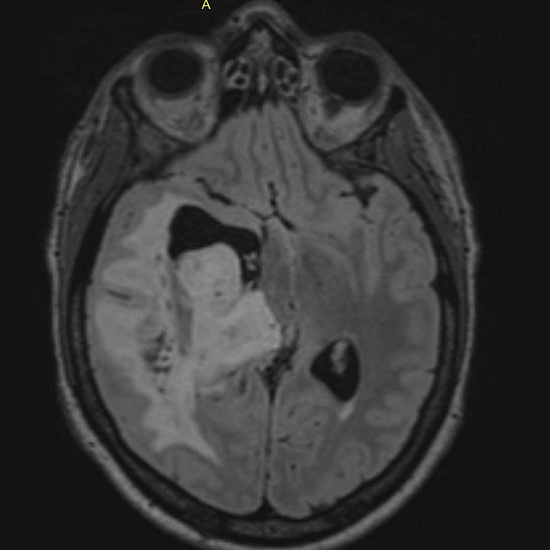Нарушение зрения на правый глаз и частая головная боль