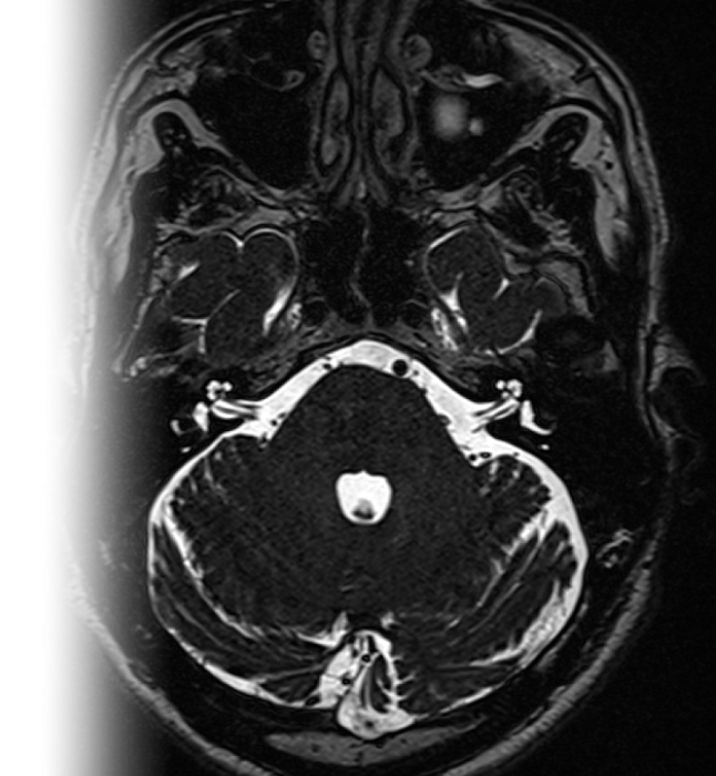 МРТ головного мозга при вазоневральном конфликте