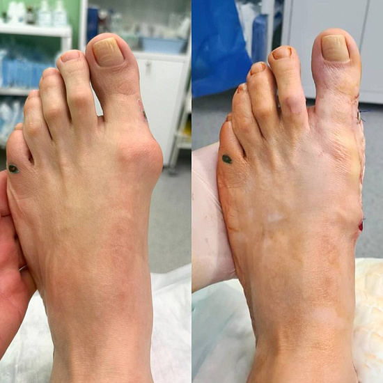 Восстановление стоп за одну операцию