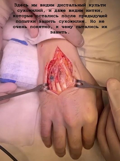 Перелом кисти хирурга