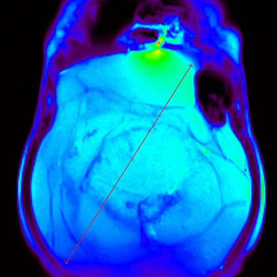Живот растет, а вес уходит