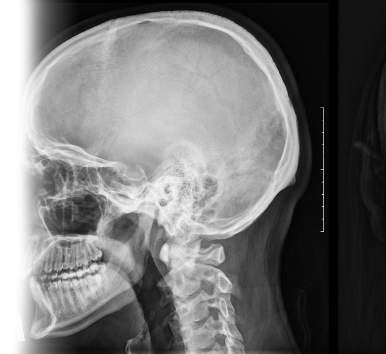 Рентгенография черепа