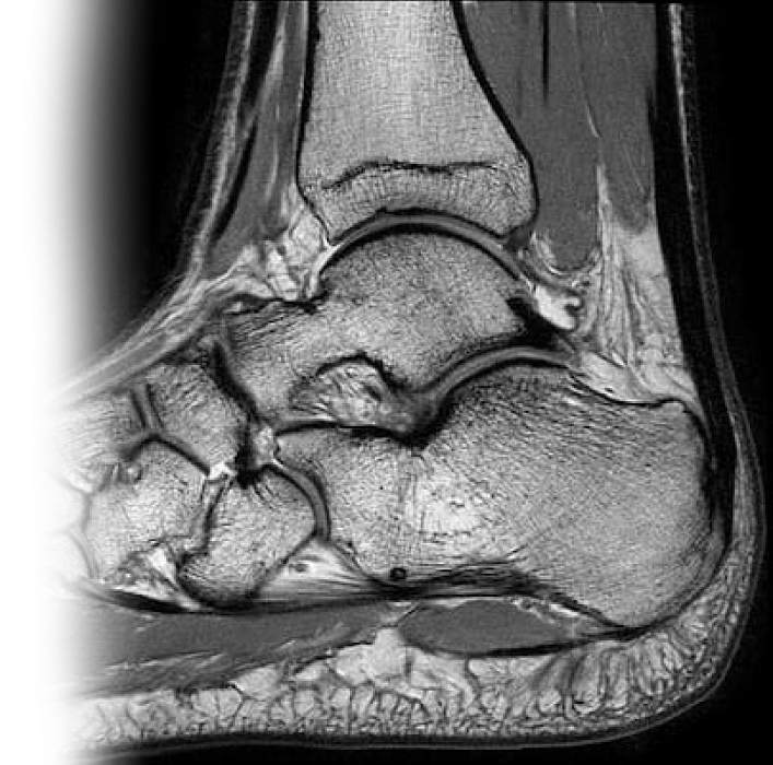 МРТ голеностопного сустава