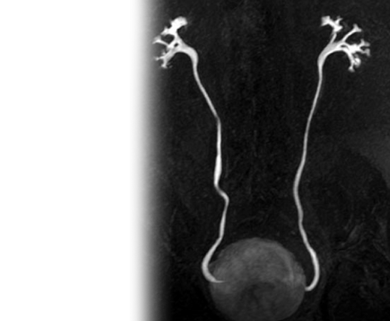 МР бесконтрастная урография