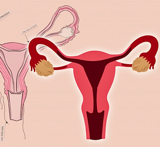 Резекция матки