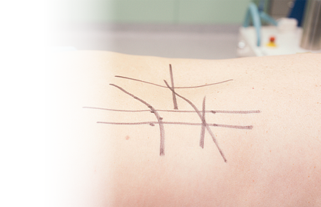 Рефлексотерапия