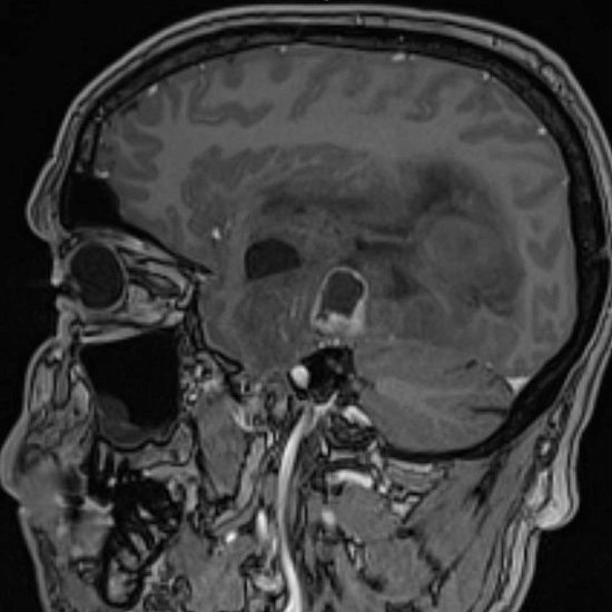 Нарушение зрения на правый глаз и частая головная боль