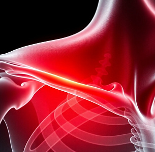 Пластика разрыва акромиально-ключичного сочленения
