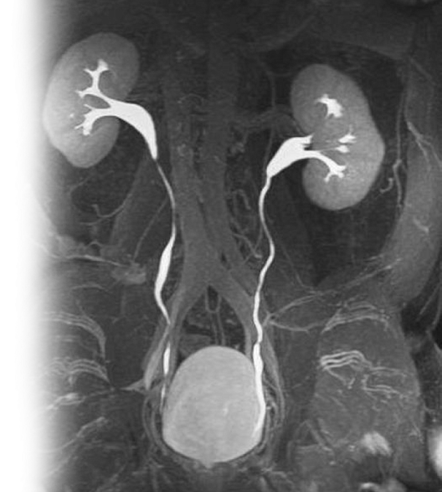 МР контрастная урография