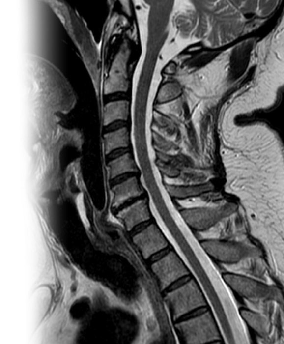 МРТ нескольких отделов позвоночника