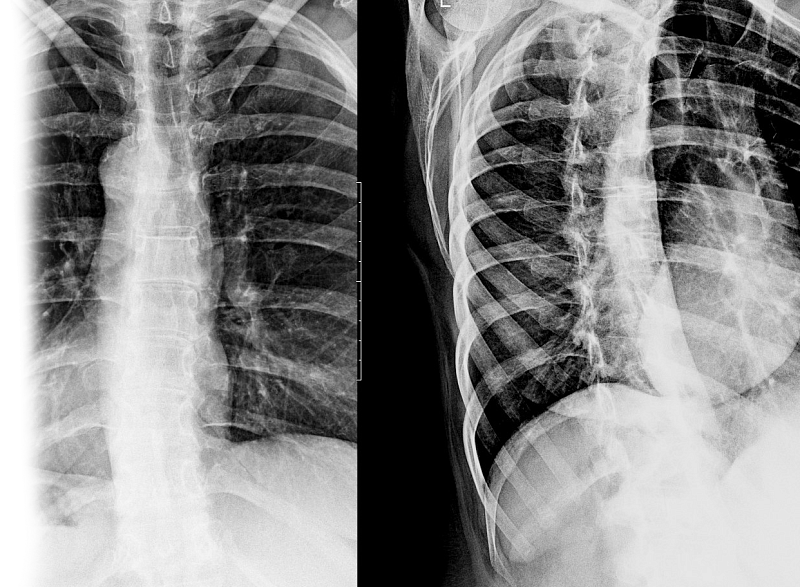 Рентгенография одного отдела позвоночника в косых проекциях