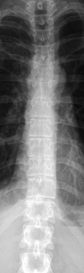 Рентгенография грудного отдела позвоночника