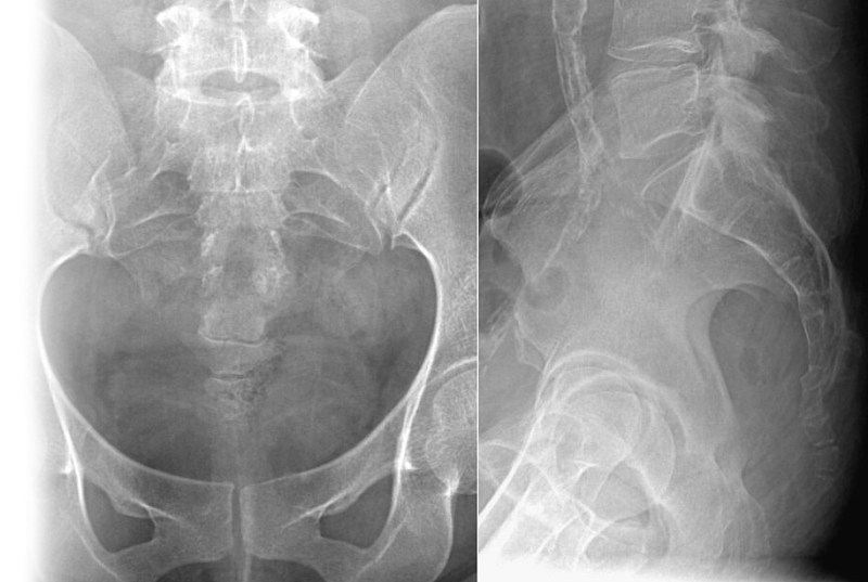 Рентгенография копчика