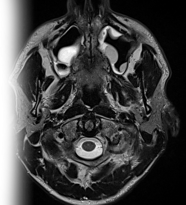 МРТ придаточных пазух носа
