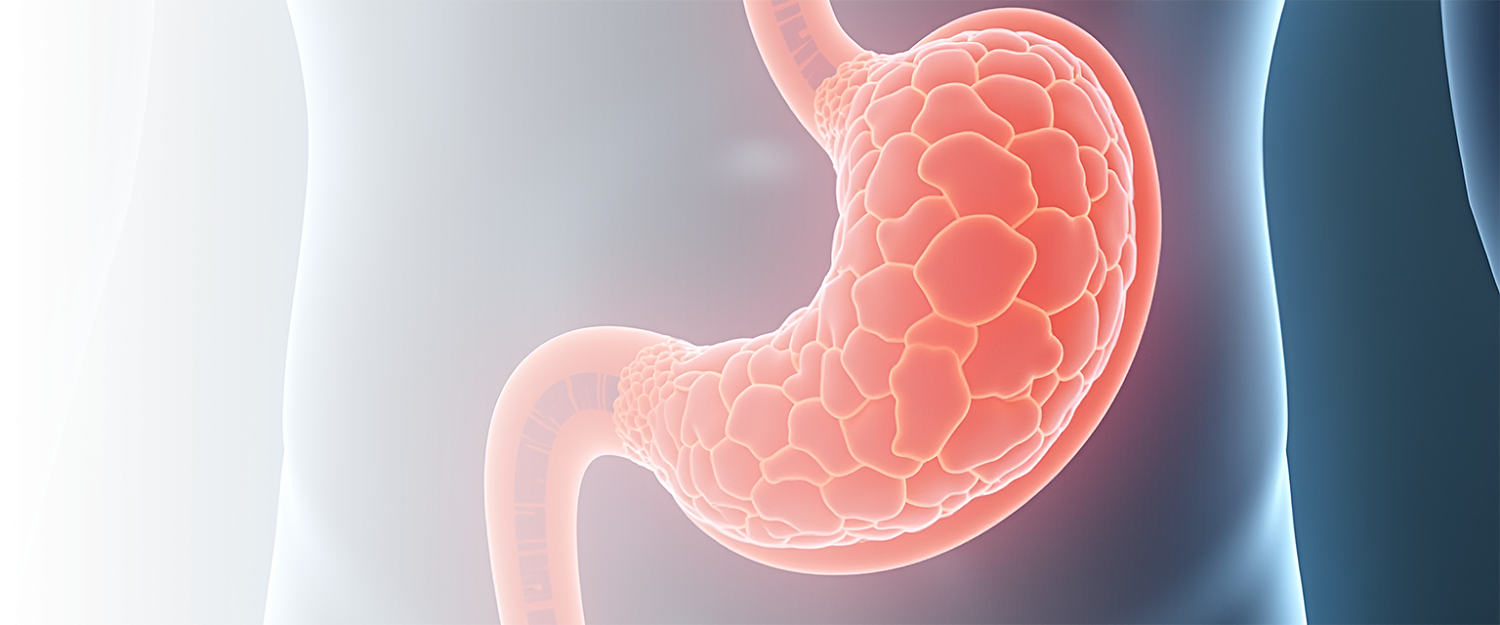 Ушивание язвы желудка и 12-перстной кишки