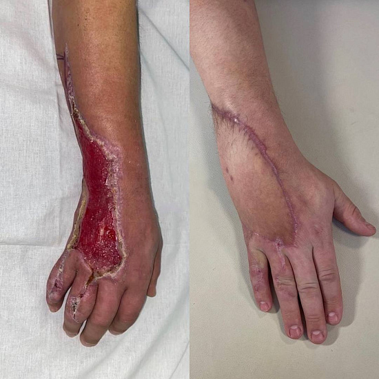 Травма кисти об забор