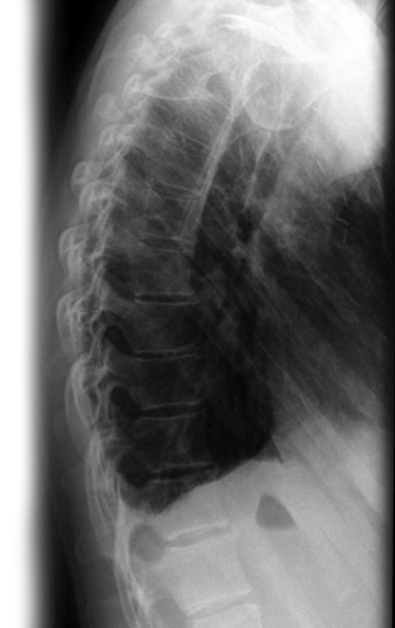 Рентгенография грудного отдела позвоночника