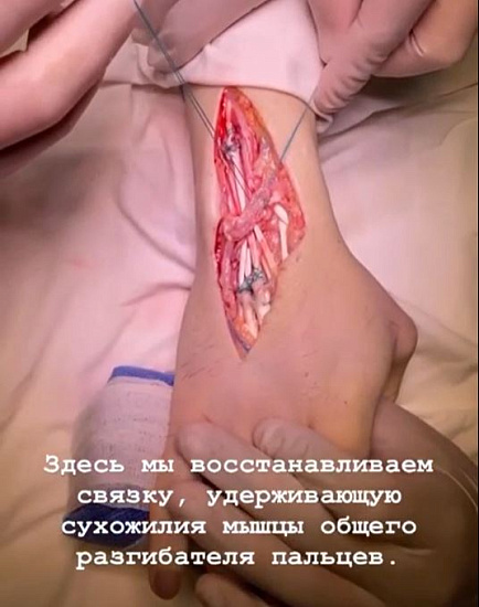 Перелом кисти хирурга