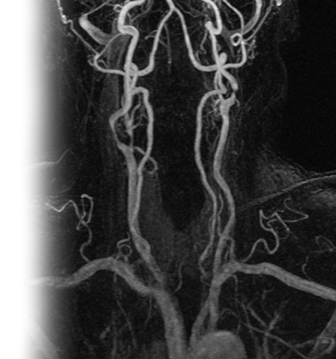 МР бесконтрастная ангиография сосудов шеи