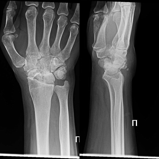 Что будет, если долго не лечить перелом?