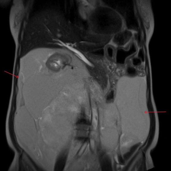 Живот растет, а вес уходит