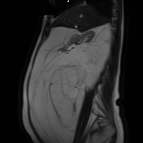 Живот растет, а вес уходит