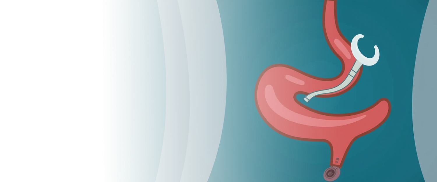 Пилоропластика