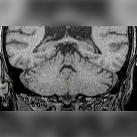 Скованная шаткость