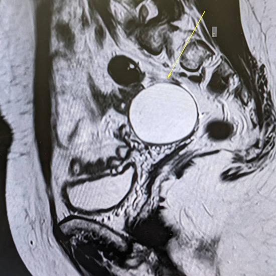 Цистаденома