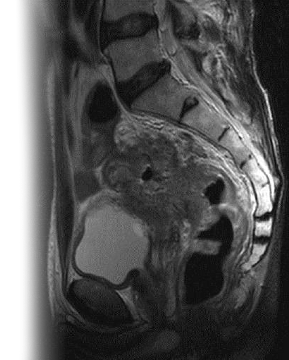 МРТ органов малого таза (муж) и наружных половых органов