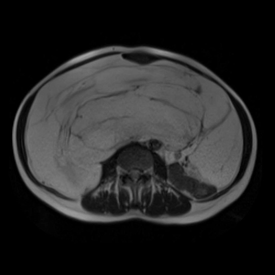 Живот растет, а вес уходит