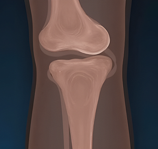 Артроскопия суставов