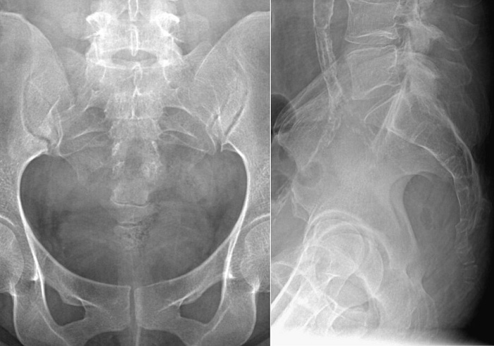 Рентгенография копчика