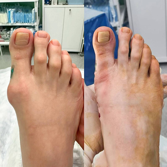 Восстановление стоп за одну операцию