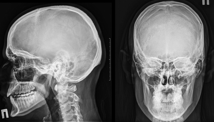 Рентгенография черепа