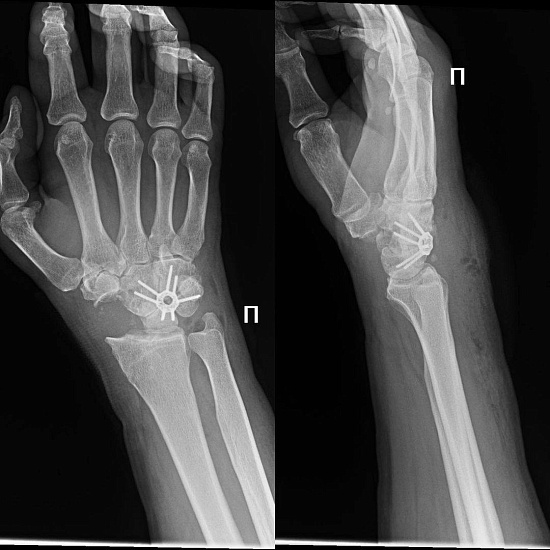 Что будет, если долго не лечить перелом?