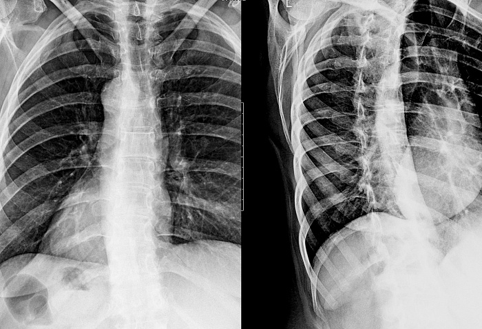 Рентгенография одного отдела позвоночника в косых проекциях